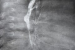 atresia-esofago-refistulizacion-condensacion-apical-der-reflujo-broncograma-bario-1m-2m-3m-6m-1984-013