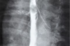 atresia-esofago-refistulizacion-condensacion-apical-der-reflujo-broncograma-bario-1m-2m-3m-6m-1984-014