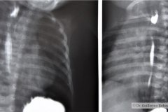 atresia-esofago-refistulizacion-condensacion-apical-der-reflujo-broncograma-bario-1m-2m-3m-6m-1984-015