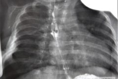 atresia-esofago-refistulizacion-condensacion-apical-der-reflujo-broncograma-bario-1m-2m-3m-6m-1984-016