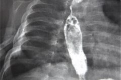 atresia-esofago-refistulizacion-condensacion-apical-der-reflujo-broncograma-bario-1m-2m-3m-6m-1984-017