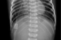 atresia-esofago-sin-fistula-2007-002