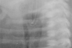 atresia-esofago-sin-fistula-traqueo-esofagica-costilla-supernumeraria-bil-2010-000