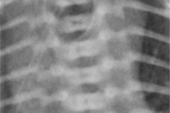 atresia-esofago-sin-fistula-traqueo-esofagica-costilla-supernumeraria-bil-2010-001