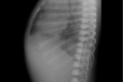 atresia-esofago-sin-fistula-traqueo-esofagica-costilla-supernumeraria-bil-2010-002