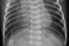 atresia-esofago-sin-fistula-traqueo-esofagica-costilla-supernumeraria-bil-2010-003