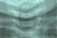 atresia-esofago-sonda-enrrollada-fractura-4-costilla-postop-pliegue-cutaneo-simula-neumotorax-rn21d-1989-001