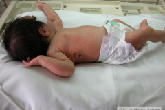 atresia-esofago-y-tubo-torax-cicatrices-postop-2005-000