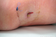 atresia-esofago-y-tubo-torax-cicatrices-postop-2005-001