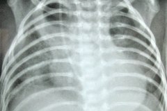atresia-esofragica-atelectasia-masiva-izq-tubo-endotraqueal-sobreinsertado-neumototax-der-doble-tubo-torax-quiste-aereo-tabicado-banda-atelectasica-segmentaria-apice-der-000