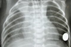 atresia-esofragica-atelectasia-masiva-izq-tubo-endotraqueal-sobreinsertado-neumototax-der-doble-tubo-torax-quiste-aereo-tabicado-banda-atelectasica-segmentaria-apice-der-001