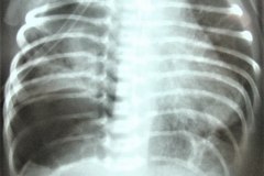 atresia-esofragica-atelectasia-masiva-izq-tubo-endotraqueal-sobreinsertado-neumototax-der-doble-tubo-torax-quiste-aereo-tabicado-banda-atelectasica-segmentaria-apice-der-002