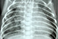 atresia-esofragica-atelectasia-masiva-izq-tubo-endotraqueal-sobreinsertado-neumototax-der-doble-tubo-torax-quiste-aereo-tabicado-banda-atelectasica-segmentaria-apice-der-003