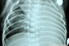 atresia-esofragica-atelectasia-masiva-izq-tubo-endotraqueal-sobreinsertado-neumototax-der-doble-tubo-torax-quiste-aereo-tabicado-banda-atelectasica-segmentaria-apice-der-004
