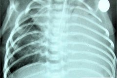 atresia-esofragica-atelectasia-masiva-izq-tubo-endotraqueal-sobreinsertado-neumototax-der-doble-tubo-torax-quiste-aereo-tabicado-banda-atelectasica-segmentaria-apice-der-005