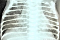 atresia-esofragica-atelectasia-masiva-izq-tubo-endotraqueal-sobreinsertado-neumototax-der-doble-tubo-torax-quiste-aereo-tabicado-banda-atelectasica-segmentaria-apice-der-006