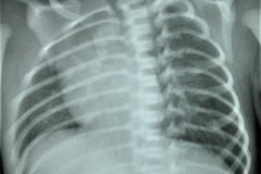 atresia-esofragica-atelectasia-masiva-izq-tubo-endotraqueal-sobreinsertado-neumototax-der-doble-tubo-torax-quiste-aereo-tabicado-banda-atelectasica-segmentaria-apice-der-007