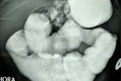 atresia-ileocecal-colon-hipoplasico-distension-ileo-mecanico-004