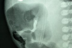 atresia-ileocecal-colon-hipoplasico-distension-ileo-mecanico-006