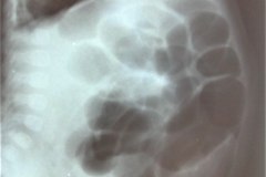 atresia-ileocolica-obtruccion-intestinal-1999-001
