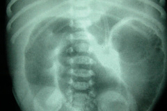 atresia-ileon-4d-2005-000