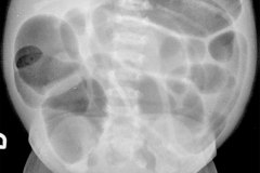 atresia-ileon-distension-abdominal-niveles-hidroaereos-001