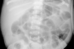 atresia-ileon-distension-abdominal-niveles-hidroaereos-002