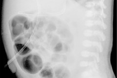 atresia-ileon-distension-abdominal-niveles-hidroaereos-003