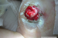 atresia-ileon-evisceracion-ileostomia-12d-2005-004