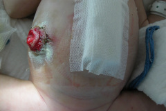 atresia-ileon-evisceracion-ileostomia-12d-2005-005