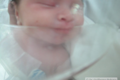 atresia-ileon-evisceracion-ileostomia-12d-2005-006