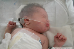 atresia-ileon-evisceracion-ileostomia-12d-2005-007