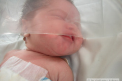 atresia-ileon-evisceracion-ileostomia-12d-2005-008