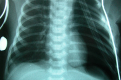 atresia-pulmonar-2003-006
