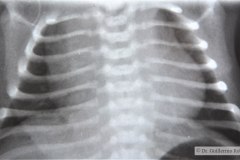 atresia-pulmonar-fistula-aortopulmonar-2003-000