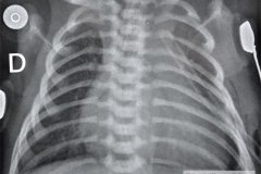 atresia-pulmonar-fistula-aortopulmonar-2003-001