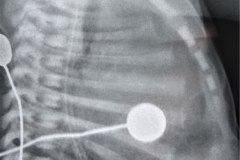 atresia-pulmonar-fistula-aortopulmonar-2003-002