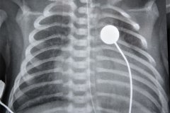 atresia-pulmonar-fistula-aortopulmonar-2003-003