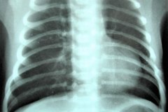 atresia-pulmonar-silueta-de-bota-o-zueco-neumotorax-izq-2003-000