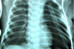 atresia-pulmonar-silueta-de-bota-o-zueco-neumotorax-izq-2003-001