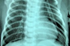 atresia-pulmonar-silueta-de-bota-o-zueco-neumotorax-izq-2003-002