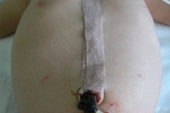 atresia-union-ileocecal-colon-hipoplasico-colostomia-doble-boca-rn-4d-10-d-2005-002