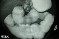 atresia-union-ileocecal-colon-hipoplasico-colostomia-doble-boca-rn-4d-10-d-2005-006