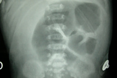 atresia-union-ileocecal-colon-hipoplasico-colostomia-doble-boca-rn-4d-10-d-2005-007