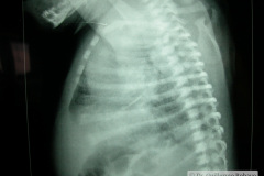 atresia-union-ileocecal-colon-hipoplasico-colostomia-doble-boca-rn-4d-10-d-2005-008