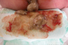 atresia-union-ileocecal-colon-hipoplasico-colostomia-doble-boca-rn-4d-10-d-2005-012