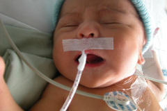 atresia-union-ileocecal-colon-hipoplasico-colostomia-doble-boca-rn-4d-10-d-2005-013