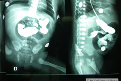 atresia-union-ileocecal-colon-hipoplasico-colostomia-doble-boca-rn-4d-10-d-2005-014