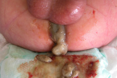 atresia-union-ileocecal-colon-hipoplasico-colostomia-doble-boca-rn-4d-10-d-2005-015