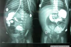 atresia-union-ileocecal-colon-hipoplasico-colostomia-doble-boca-rn-4d-10-d-2005-016